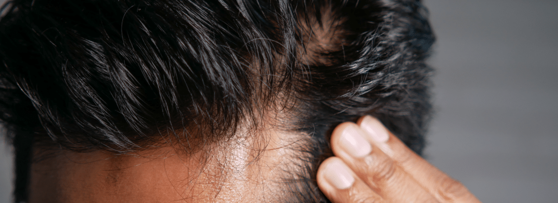 Cheveux gras homme