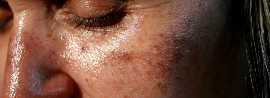 Apparence de tâches brunes sur un visage