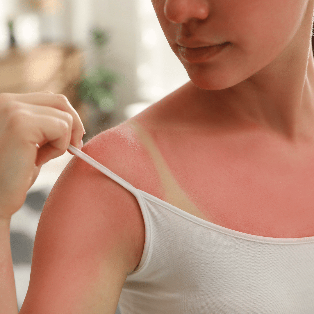Protégez votre peau et évitez les coups de soleil avec nos conseils et produits solaires.