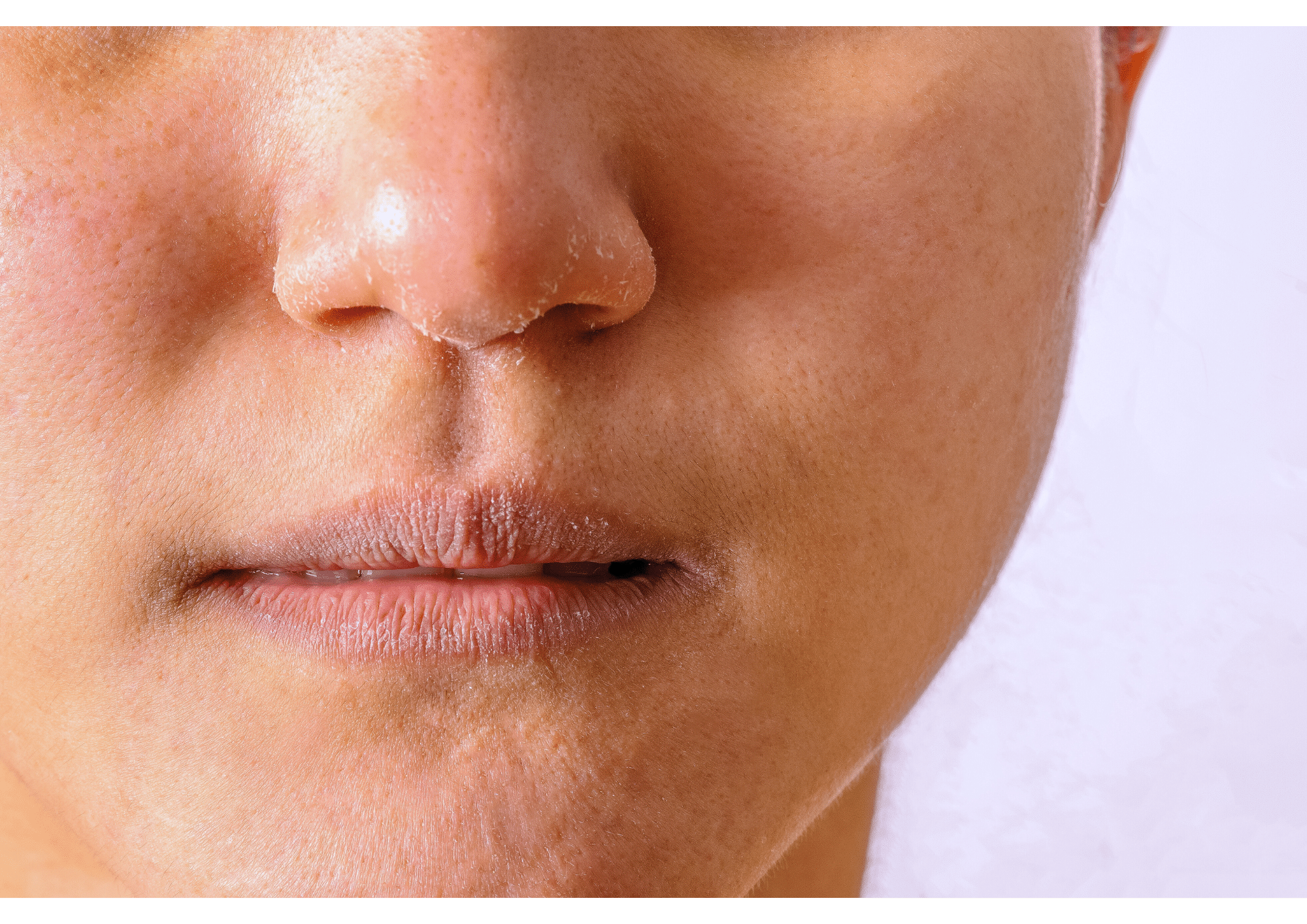 Peau du visage sèche, gercée et présentant des irritations dues au froid hivernal.